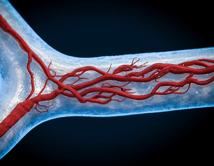 Angiólogo Pachuca_sintomas