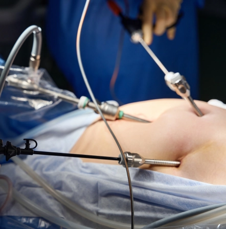 Cirugía Laparoscópica_beneficios