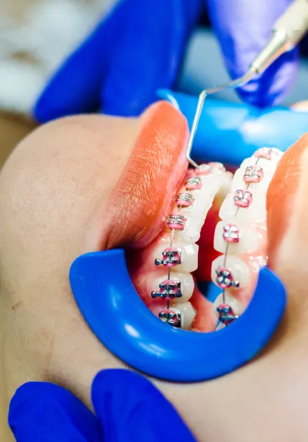 Ortodoncista_pachuca_beneficios